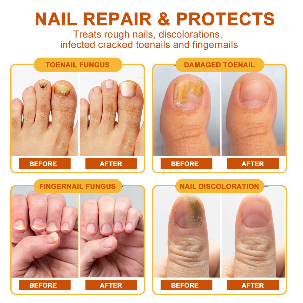 Sumifun - Bee Venom Fungal Nail Treatment Cream