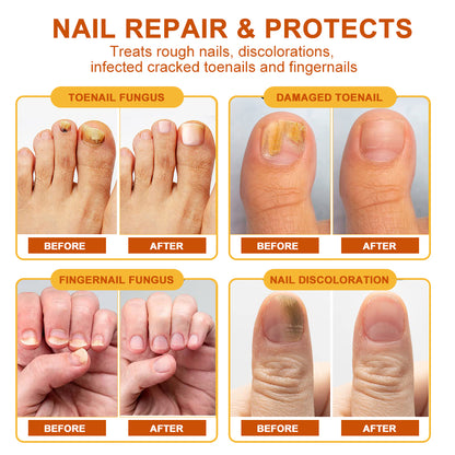 Sumifun - Bee Venom Fungal Nail Treatment Cream